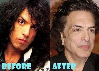 A picture of Paul Stanley before (left) and after (right).